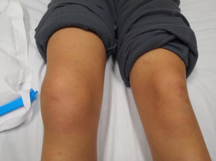 деформация на колянната става с артроза